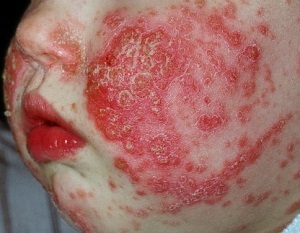 Atheroma a gyermek a fej, az arc vagy a mellkas és fotó tippeket Komarovsky (atheroma) Atheroma a gyermek a fej, az arc vagy a mellkas, és fotó tippek Komarovka