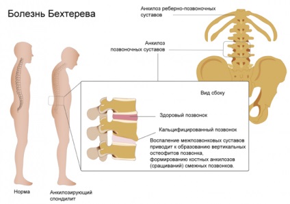 A Bechterew-kór vagy a spondylitis ankylopoetica - Tünetek, okai és kezelések