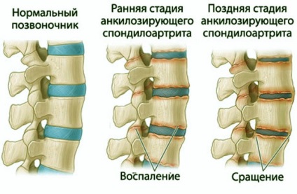 A Bechterew-kór vagy a spondylitis ankylopoetica - Tünetek, okai és kezelések