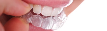 Invisalign zárójelek (US) - hatékony és látható mások