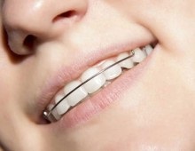 Invisalign zárójelek (US) - hatékony és látható mások