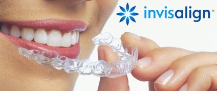 Invisalign zárójelek (US) - hatékony és látható mások