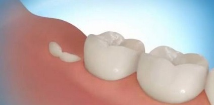 Ahhoz, hogy a fogak nőtt a harmadik alkalommal, szükség van egy megbízás