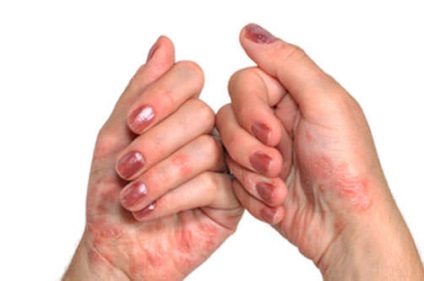 Ekcéma az ujjai a kezében az okai, tünetei és kezelése
