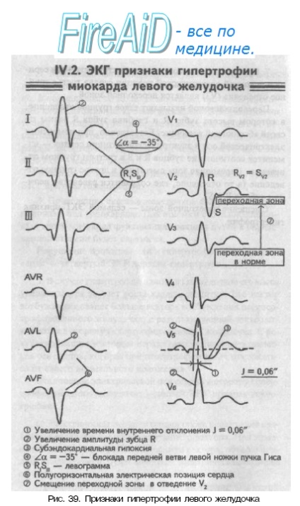 Elektrokardiográfiás (EKG) bizonyíték a szívizom hypertrophia