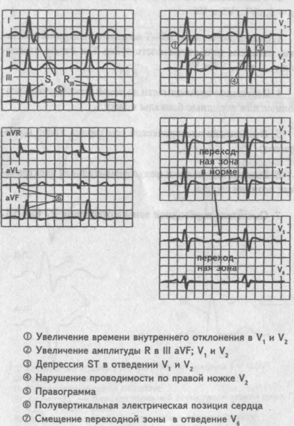 Elektrokardiográfiás jelei szívizom hipertrófia - kardiológus - egy telephely szívbetegségek és a