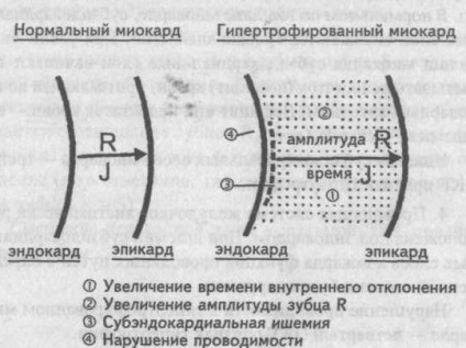 Elektrokardiográfiás jelei szívizom hipertrófia - kardiológus - egy telephely szívbetegségek és a