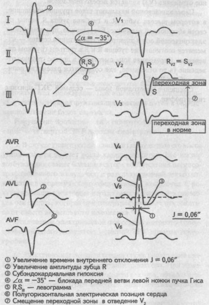 Elektrokardiográfiás jelei szívizom hipertrófia - kardiológus - egy telephely szívbetegségek és a