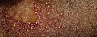 A nemi dermatitisz férfiakban és annak kezelése - Kenhető-e a pénisz napraforgóolajjal