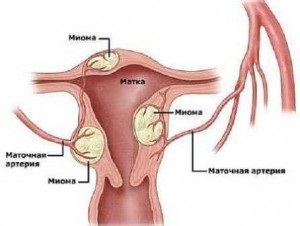 Mióma, és mióma mi a különbség, kezelési módszerek (kezelés) Mióma, és mióma mi a különbség, kezelési eljárásokat