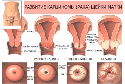 A genitális szemölcs kezelés, okai és képek