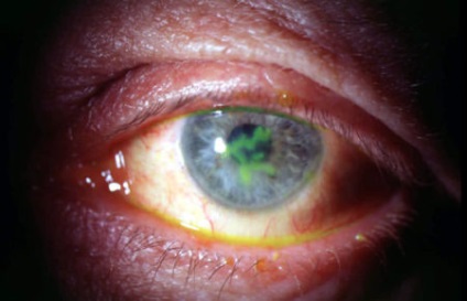 Herpeszes szaruhártya a szem tünetek és a kezelés (keratitis) Herpeszes szaruhártya a szem tünetek és a kezelés
