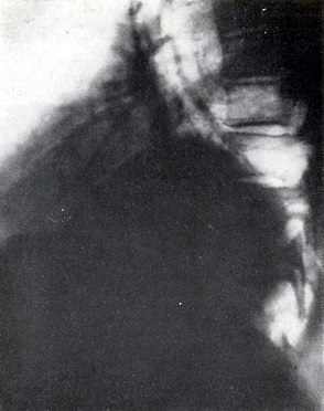 Óriás tüdőfibrózis (fibroma) Óriás tüdőfibrózis