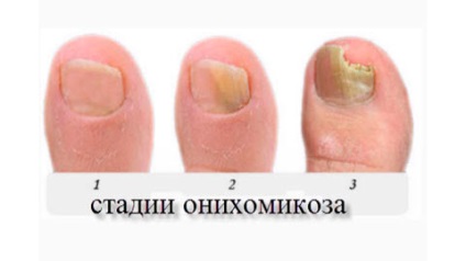 gombák nail diagnózis és kezelés)