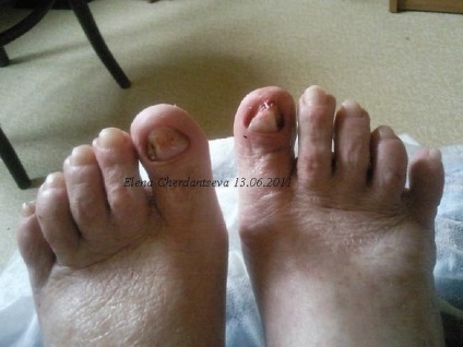 nail gombák a láb kezelése és jelek)