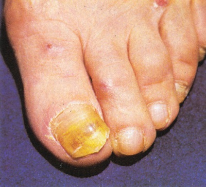 nail gomba a lábak kezelésére közben cukorbetegség)