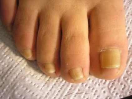 nail gomba a lábak kezelés cukorbetegséggel)