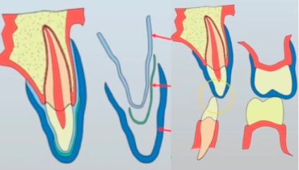 Testreszabott sportok mouthguards