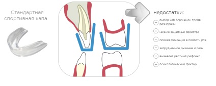 Egyedi sport mouthguards (Egyedi sport mouthguards Smile) Testreszabott sportok mouthguards