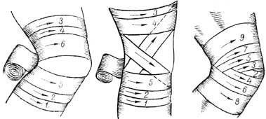 Як бинтувати еластичний бинт на коліно