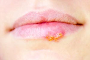Milyen gyorsan gyógyítja a herpesz az ajkak 1 nap otthon