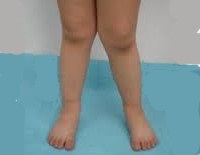 Hogyan erősít az X-alakú láb deformitások gyermekek Pediatric Research Institute