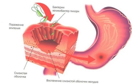 Hurutos bulbit gyomor -, hogyan kell kezelni a betegséget