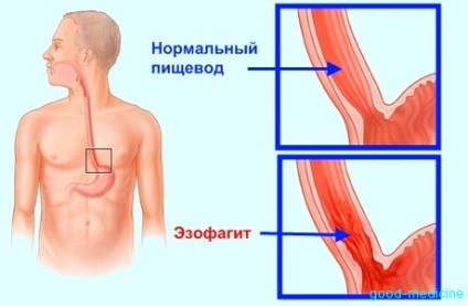 Hurutos Reflux oesophagitis, mi az oka, diagnózis és kezelés