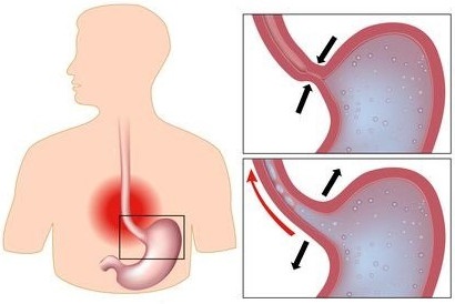 Hurutos Reflux oesophagitis okok és betegségek klinikán