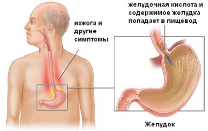 Hurutos Reflux oesophagitis okok és betegségek klinikán