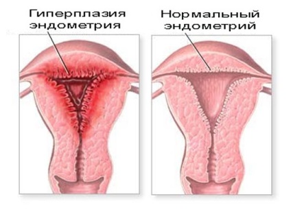 Amikor a kaparás az endometrium