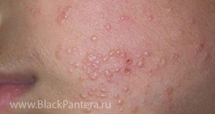 Molluscum contagiosum gyermekek tünetei és kezelése