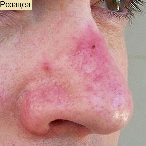 Red Nose Okok és kezelések, bőrpír fotó