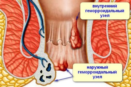 aranyér kezelésére anélkül, konzervatív műtét és minimálisan invazív módszerek