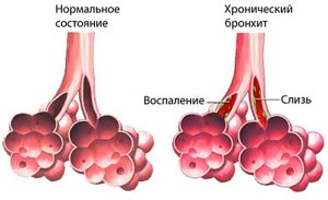 Antibiotikum krónikus bronchitis (krónikus bronchitis kezelése) A krónikus bronchitis kezelés antibiotikumokkal