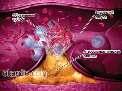 Mesenterialis thrombosis, okai, tünetei, diagnózis és kezelés