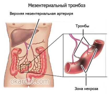 Mesenterialis thrombosis, okai, tünetei, diagnózis és kezelés