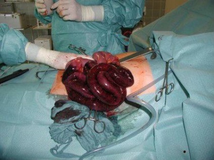 A mesenterialis vascularis trombózis bél (akut és krónikus) (mesenterialis érrendszeri trombózis) A mesenterialis vascularis trombózis bél (akut és krónikus)