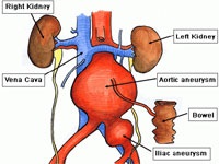 A mesenterialis vascularis trombózis bél (akut és krónikus) (hajók) A mesenterialis vascularis trombózis bél (akut és krónikus)