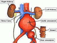 A mesenterialis vascularis trombózis bél (akut és krónikus)