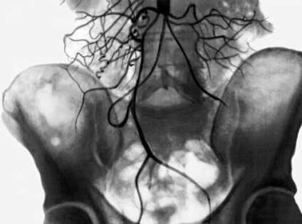 A mesenterialis vascularis trombózis bél (akut és krónikus)