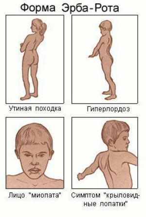 A myopathia Erb - hogy prestavlyayuschie betegség