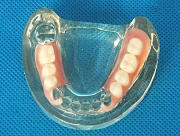 Різноманіття зубних протезів який вибрати