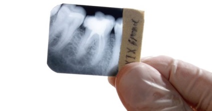 Lehetséges, hogy nem egy x-ray a fogak a terhesség alatt, hogy megtudja, mi a cikket! (Terhesség) Lehetséges, hogy nem egy x-ray a fogak a terhesség alatt, hogy megtudja, mi a cikket!