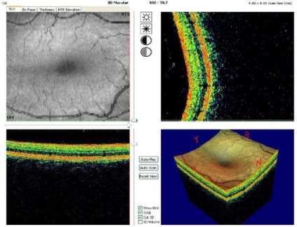 Optikai koherencia tomográfia a szem