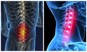 Osteoarthritis a gerinc tünetek és a kezelés a nagy perifériás ízületek (osteoarthritis) Osteoarthritis a gerinc tünetei és kezelése nagy perifériás ízületek