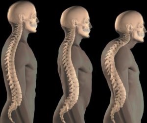 Osteoarthritis a gerinc tünetek és a kezelés a nagy perifériás ízületek (kezelés) Osteoarthritis a gerinc tünetei és kezelése nagy perifériás ízületek