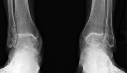 osteoarthritis tünetek diagnosztikai kezelése hány nap fáj az ízület