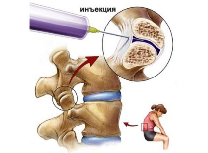 Osteoarthritis a gerinc, a nyaki, ágyéki, mellkasi