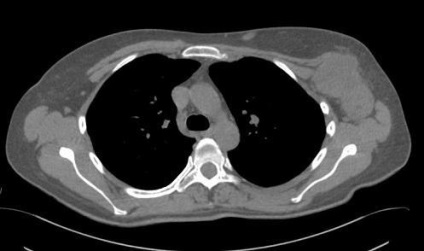 Osteosclerosis gerinc tünetek és a kezelés